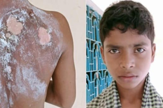 বাঁশখালীতে মাদ্রাসা শিক্ষার্থীকে গরম পানিতে ঝলসে দিলেন শিক্ষক